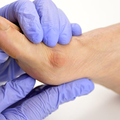Foot with a bunion