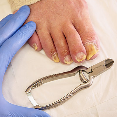 Fungus on the toes nails. Twisted toes on the foot with calluses.  Hallux rigidus
